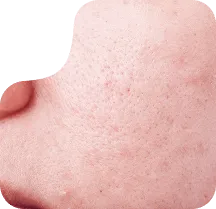 blogs-skin