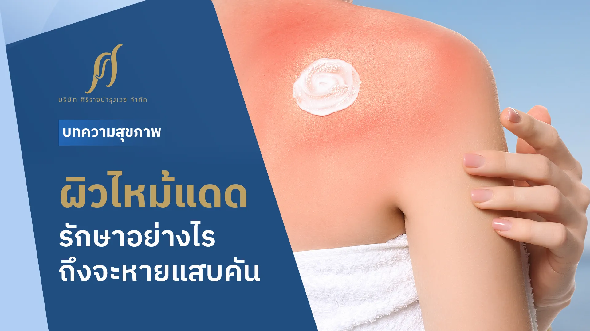 ผิวไหม้แดด รักษายังไง-ใช้อะไรถึงจะให้หายแสบ