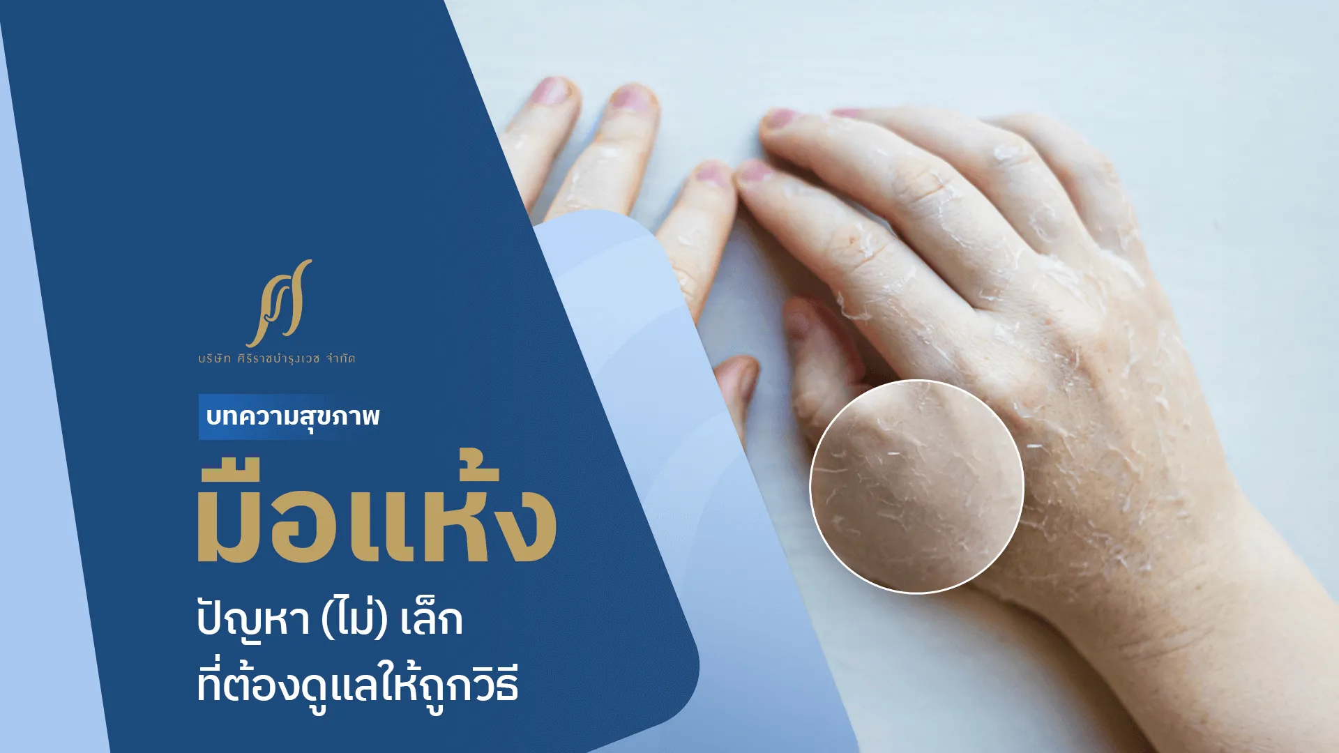 “มือแห้งลอก” ปัญหา(ไม่)เล็กที่เรื้อรัง พบวิธีรักษาและดูแลผิวมือที่ทำได้เองที่บ้าน